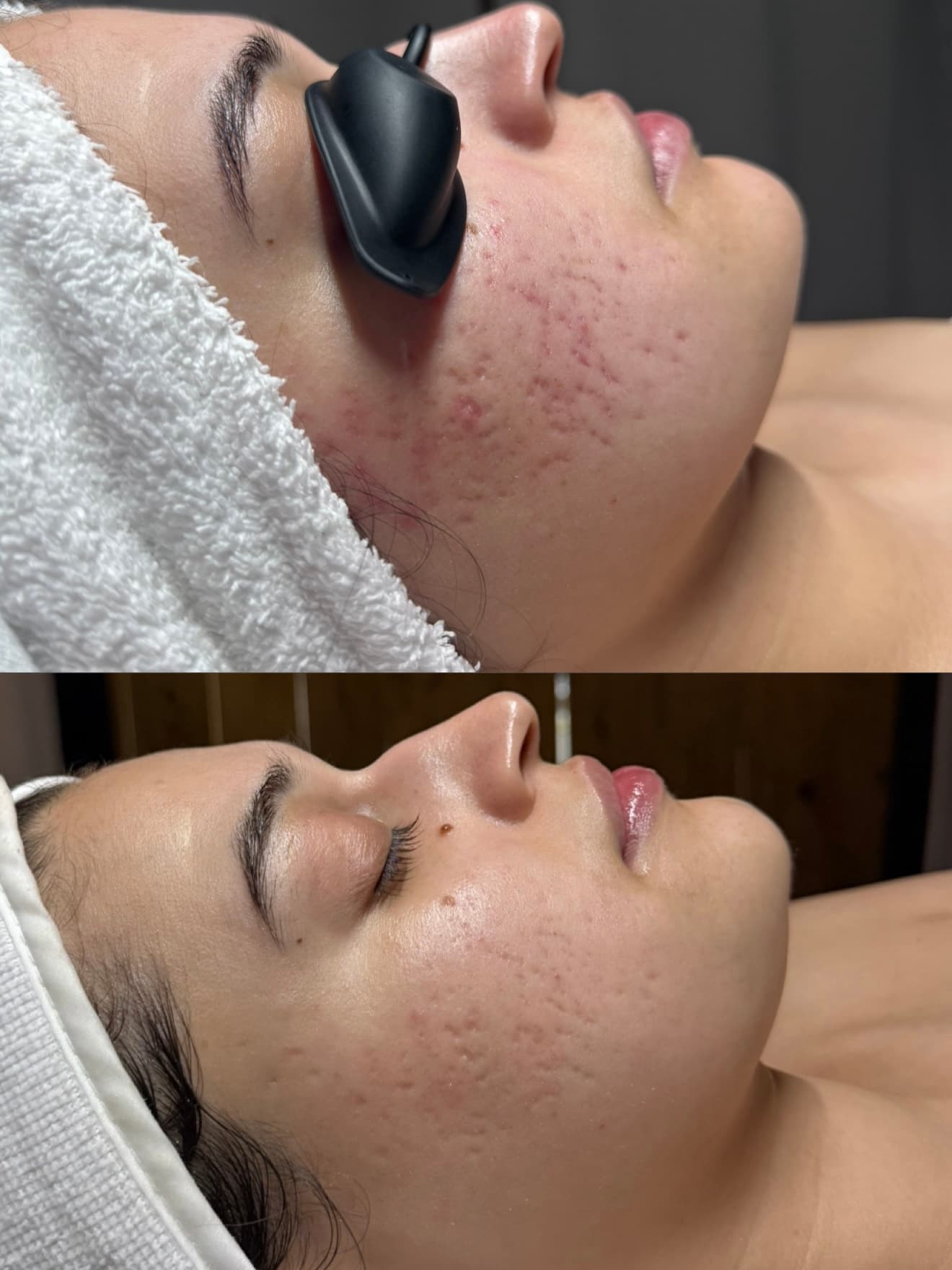 Before and after: acne on the cheek, visibly clearer after treatment