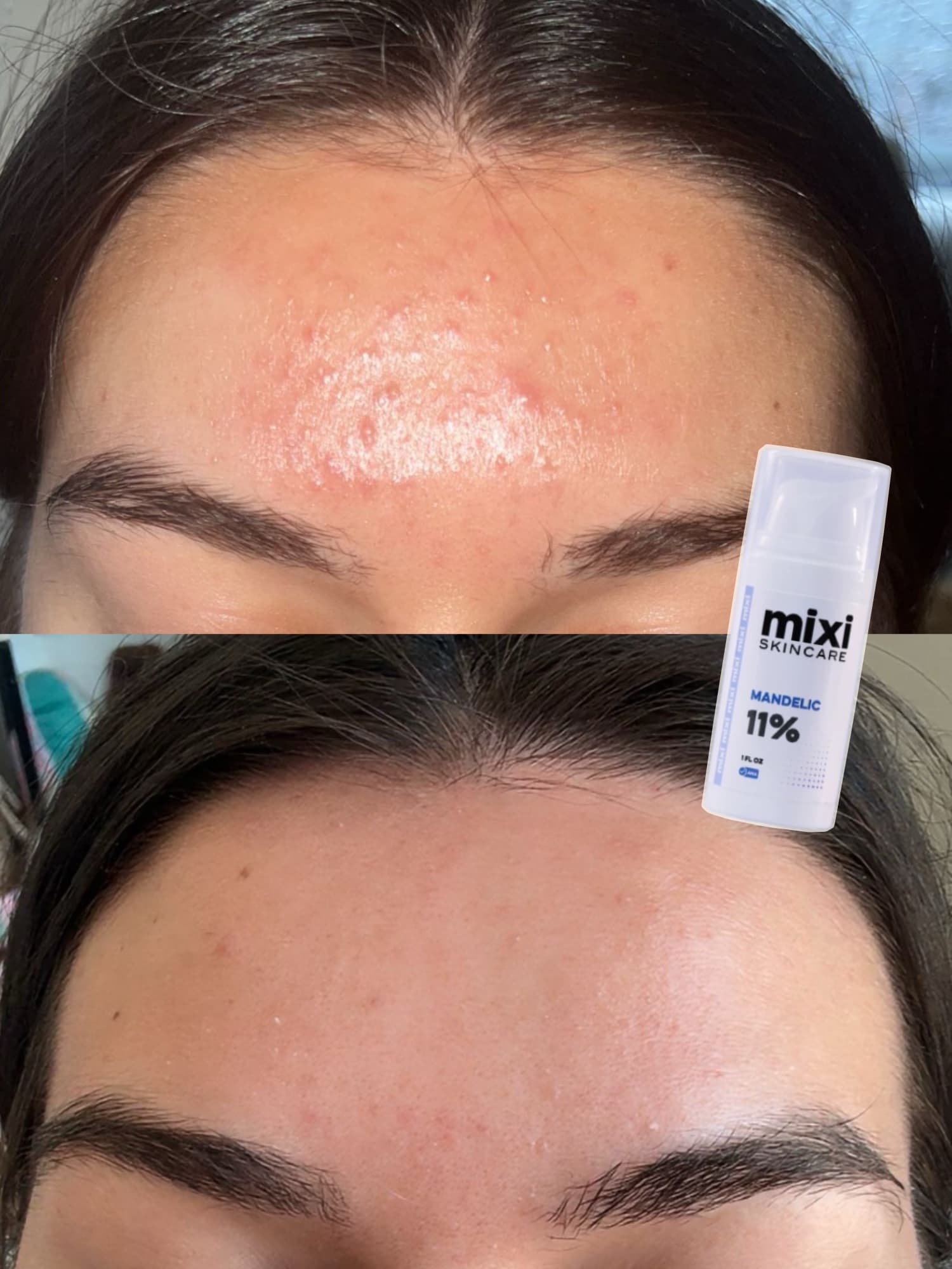 Before and after: forehead texture and breakouts, smoother after treatment